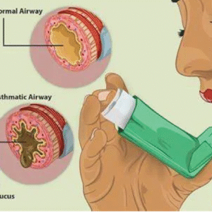 علاج الربو بدون ادوية